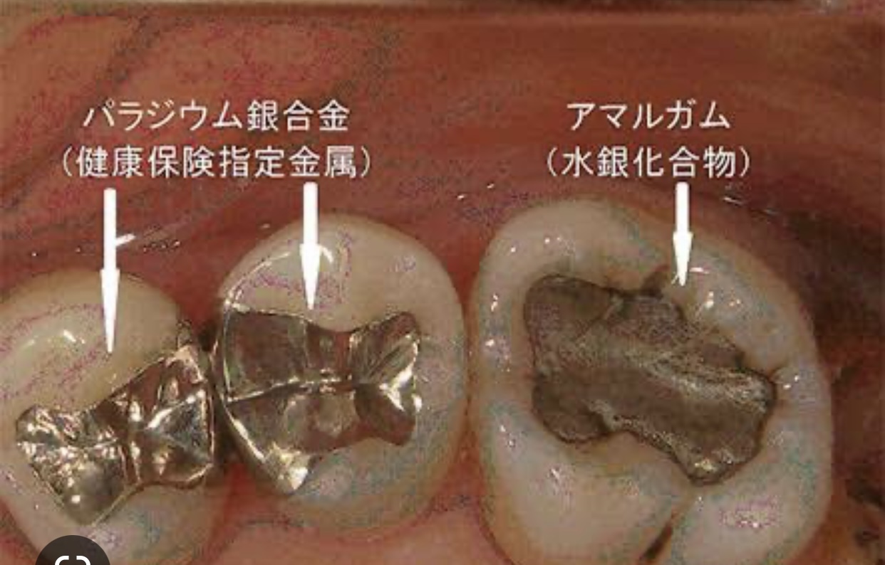 歯科　金属　パラジウム